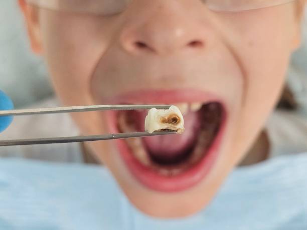 Best Cracked Tooth Emergency Dentist  in Mi Wuk Village, CA